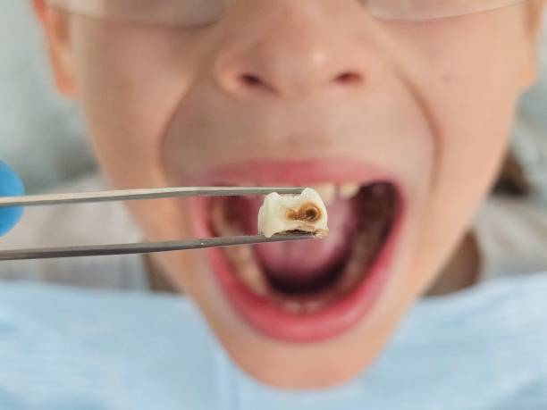 Best Emergency Root Canal Treatment in Lincoln, MO